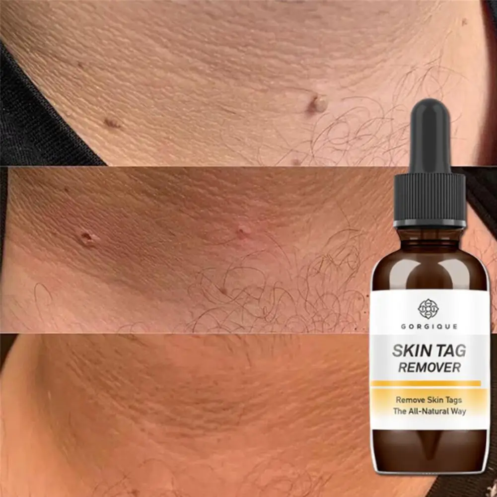 

10/20/30ml Wart Liquid Skin Tag Remover Essence Papillomas Against Serum Treatment Skin Care Liquid Remover Corn Wart Mole D4C3