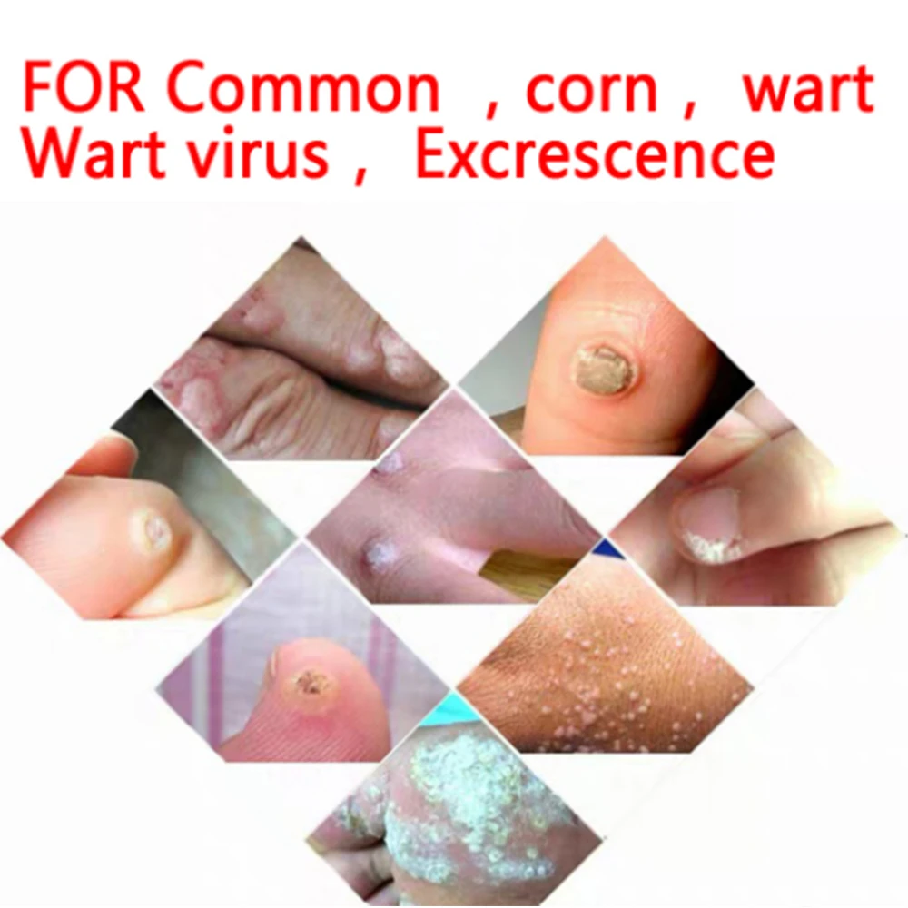 Китайский медицинский бородавок мазь для удаления мозолей ног тег кожи пластырь