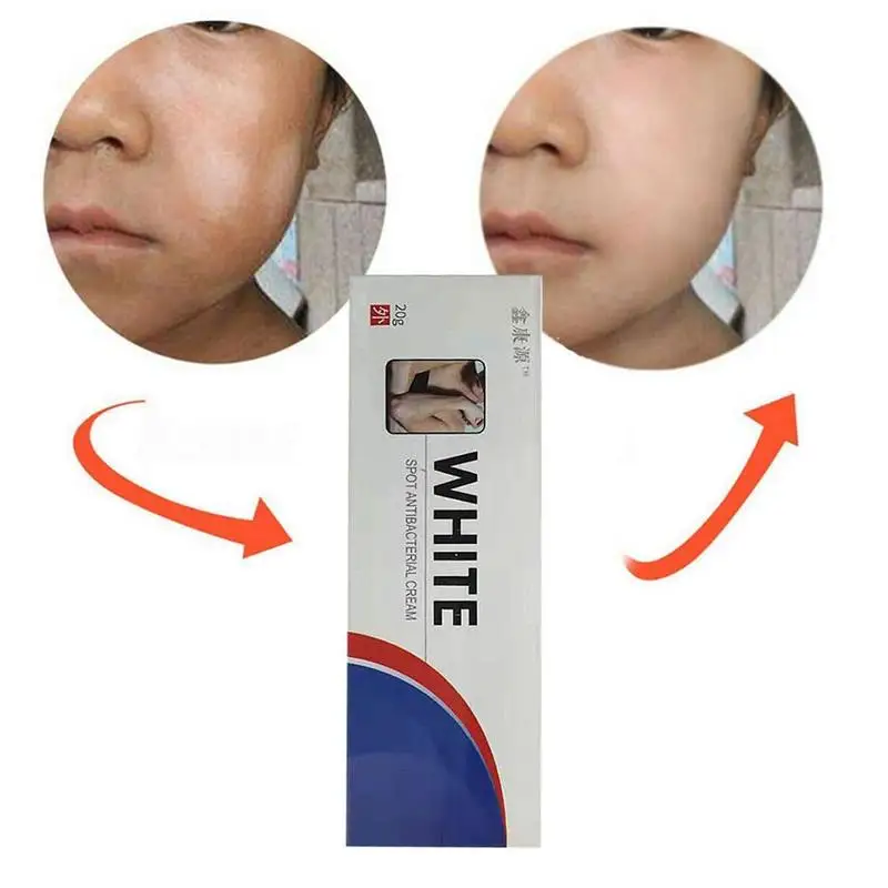 

20g Chinese Medical White Spot Disease Cream Pigment Melanin Promoting Liniment Skin Vitiligo Leukoplakia Disease Treatment