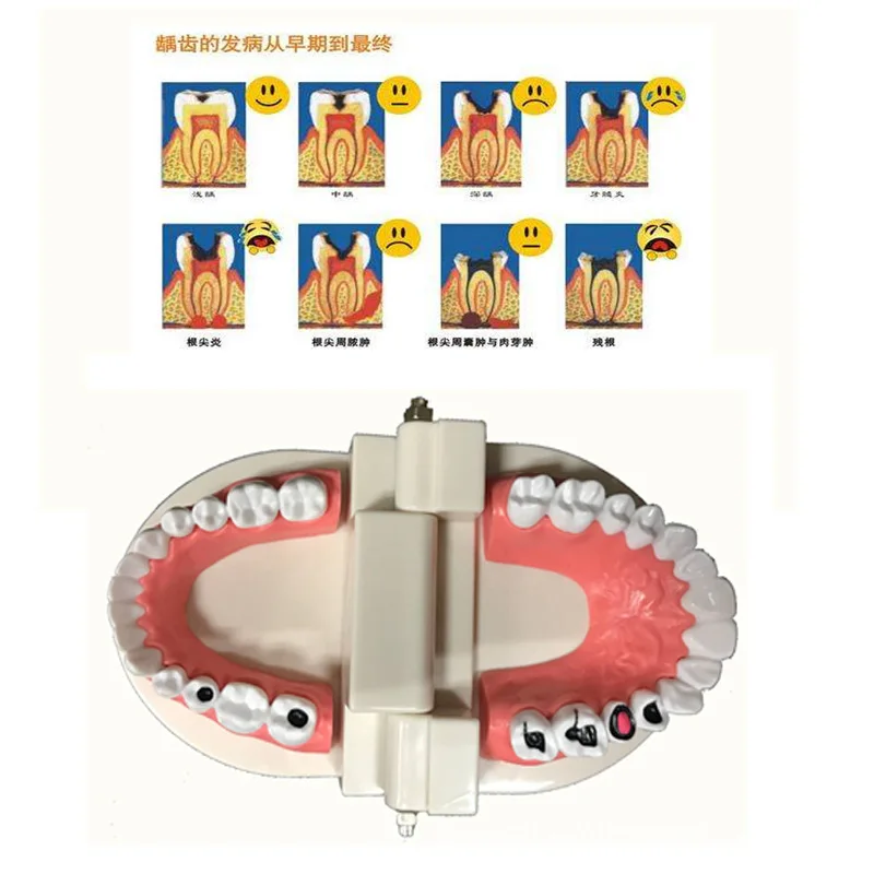 ABS PVC Dental Model Oral Instrument Tools Consumables Tooth Decay Medical Care Teaching Aids Teeth | Канцтовары для офиса и