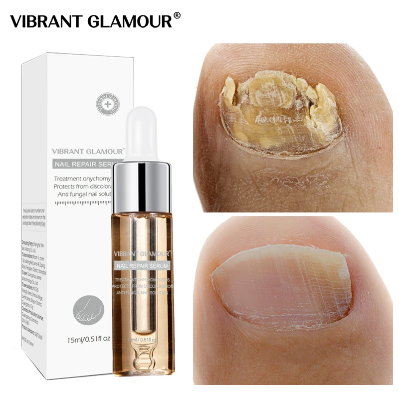 Vibrantglamur грибковый Уход за ногтями, сыворотка для ухода за ногами, гель для удаления грибка для ногтей, анти-инфекционный паронихический онихомикоз