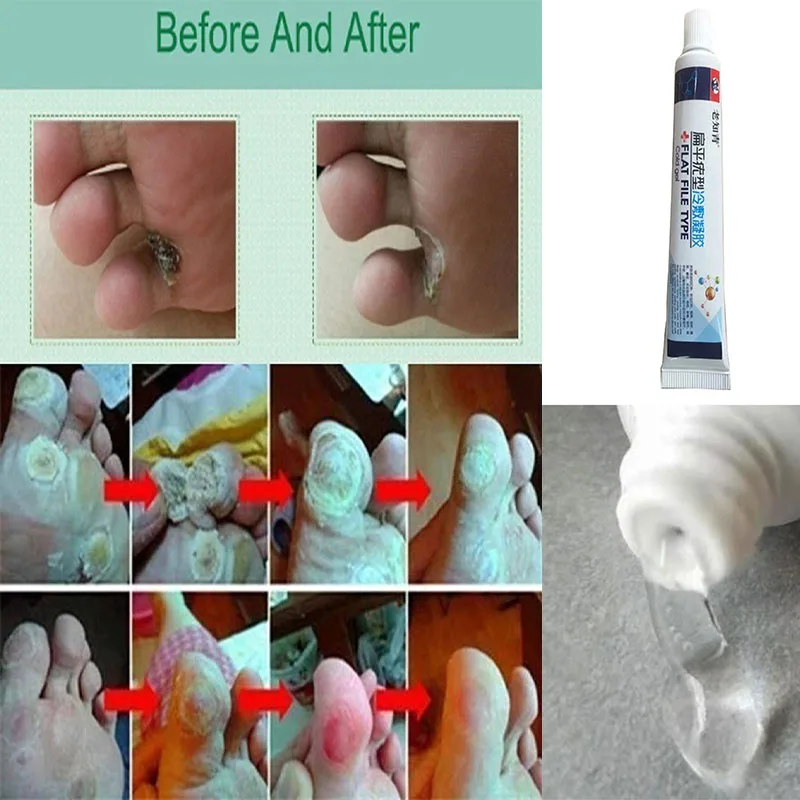 Удаление бородавок на коже удаление жидкости с кожи моли|Устройство для ухода за