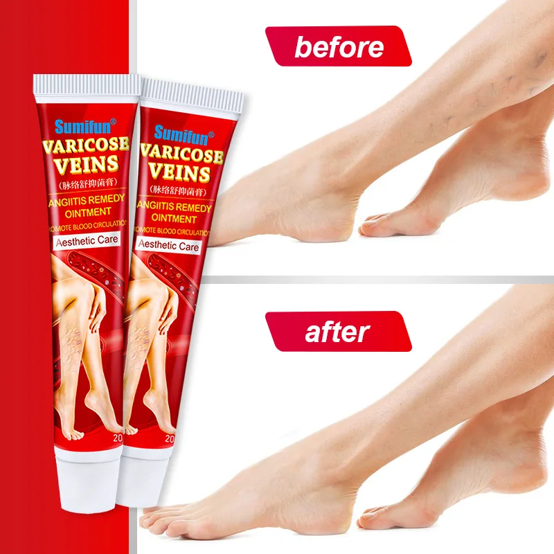 

Body Cream Varicose Vein Cream Skin External Ointment Treatment Skin Men and Women Body Care