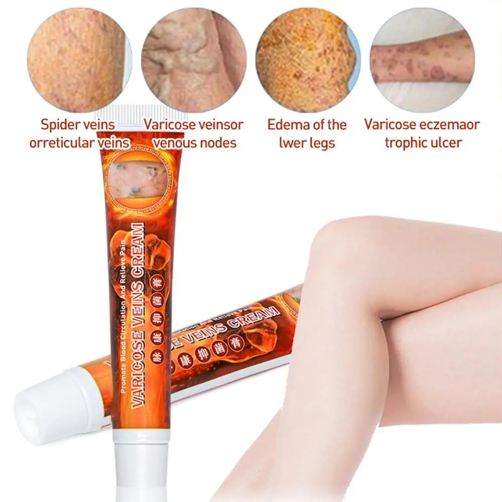 20g Varicose Veins Treatment Cream Herbal Vasculitis Phlebitis Pain Relief Angiitis Inflammation Rotten Legs Ointment Foot Care | Красота и