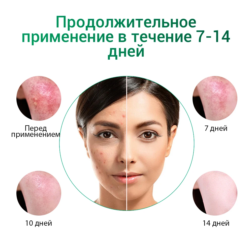 Breylee маска для лица крем для лица сыворотка для лица от прыщей лечение акне Сыворотка для ухода за кожей лица Маска Крем против акне крем отбеливающий крем маски для лица устройство для удаления прыщей инструменты