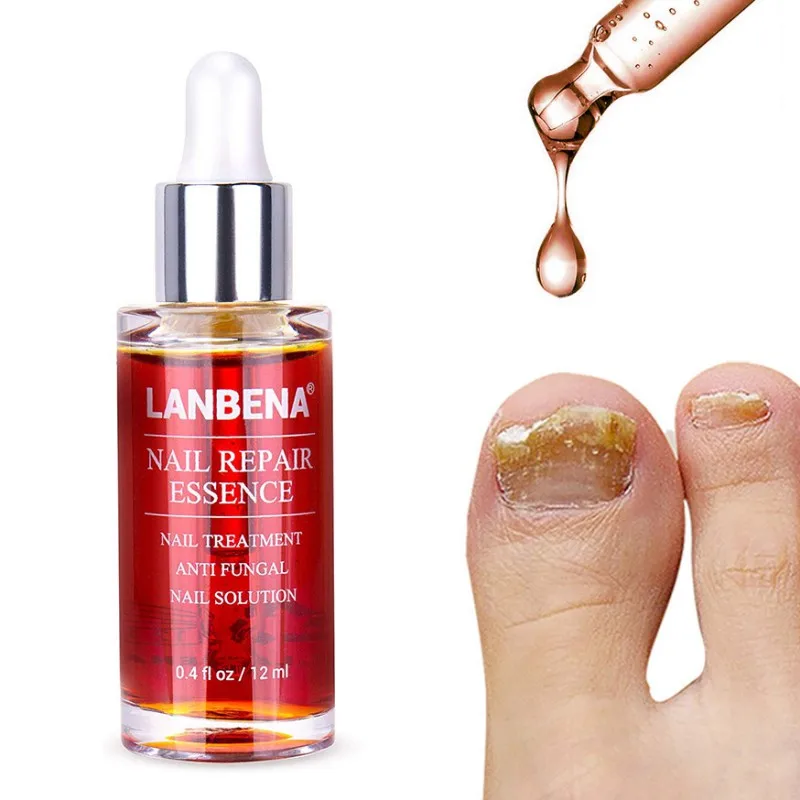 Грибковое Лечение ногтей мощное удаление грибка анти-инфекция Paronychia Onychomycosis