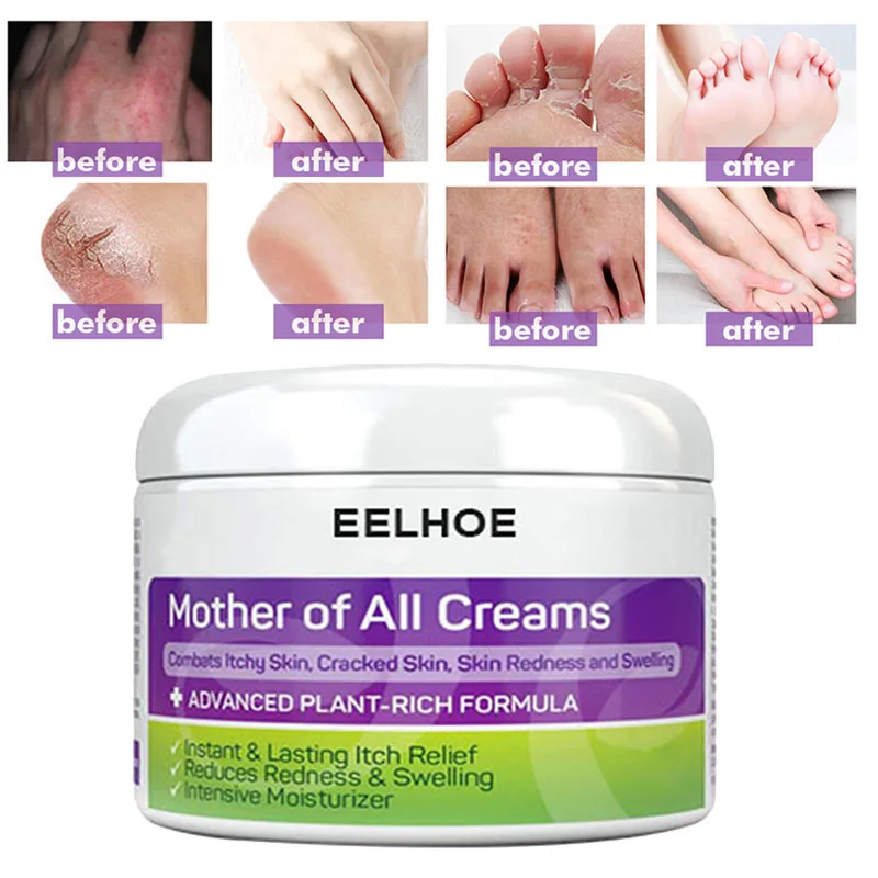 

Крем для лица EELHOE Eczema, уход за кожей лица, растительная богатая формула, мгновенное увлажнение, длительный срок службы, для сухого треснувше...