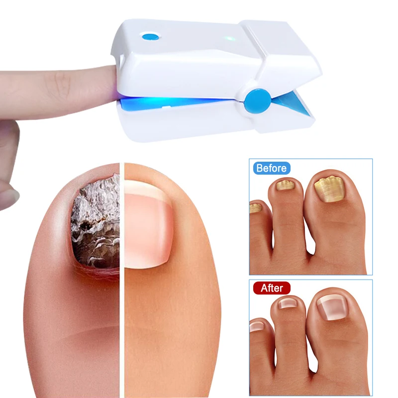 Home use laser for nail fungus treatment Cure Fungus Onychomycosis Painless Therapy Treatment For Toes And Fingernails | Красота и