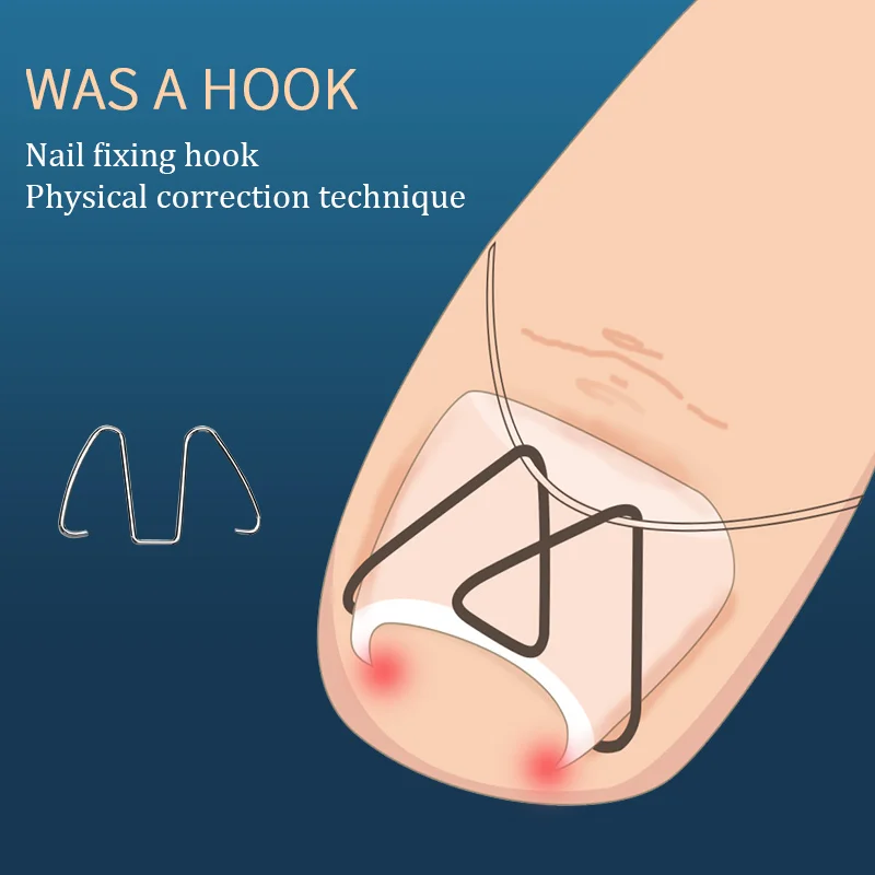 Orthodontic correction of nails and in the meat | Красота и здоровье