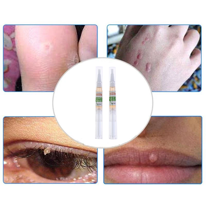 2 шт. ручка для удаления следов кожи 5 дней естественного здоровья родинки невус| |