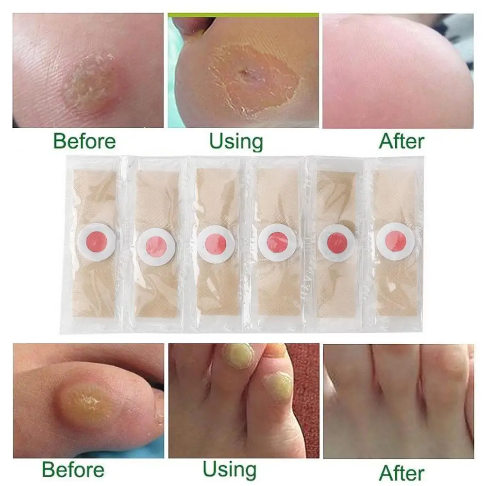 

Foot Corn Killer Calluses Plantar Warts Thorn Pain Foot Protector Sticker Tool Relief Plaster Toe Medical Care L5M2