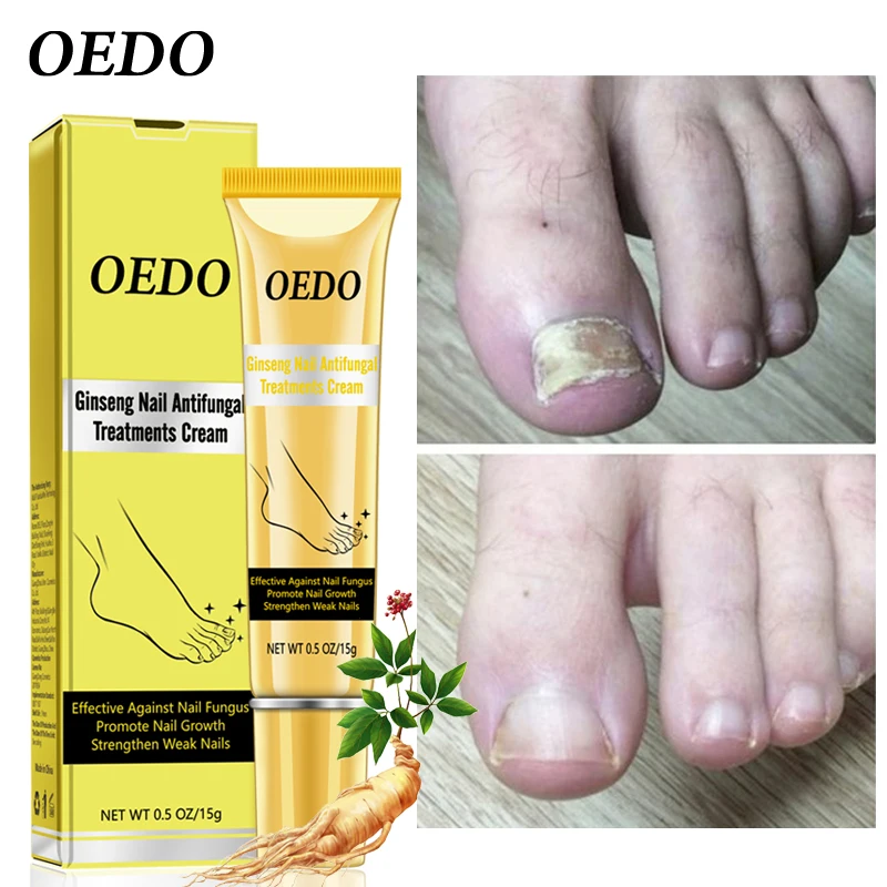 Herbal Fungal Nail Treatment Ginseng Antifungal Treatments Cream Removal Repair Essence Onychomycosis Foot | Красота и здоровье
