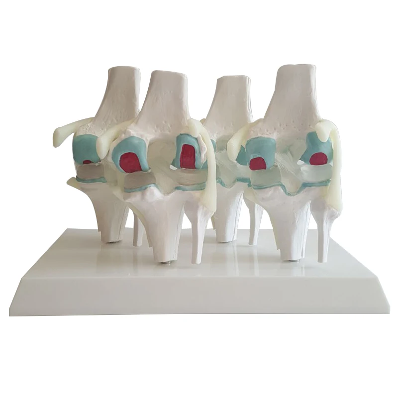 Модель для лечения заболевания коленного сустава патология модель