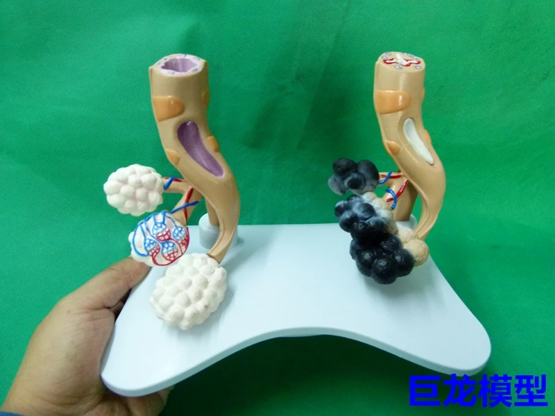 

Human Lung Anatomy Diseased Healthy Alveoli Comparison Model Demonstration Teaching Model