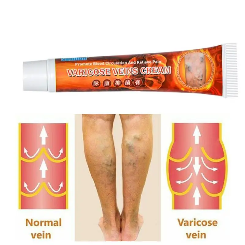 Варикозное расширение вен лечение крем мазь васкулит флебит ангиит воспаление