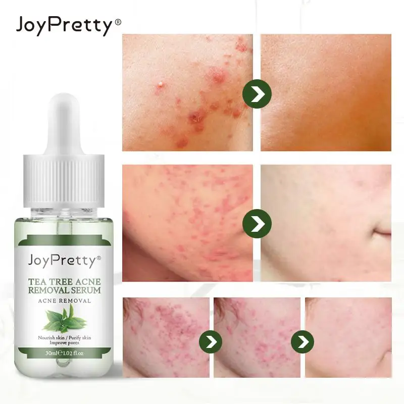 Сыворотка JoyPretty TSLM1 для ухода за кожей лица сыворотка снижения прыщей гладкой