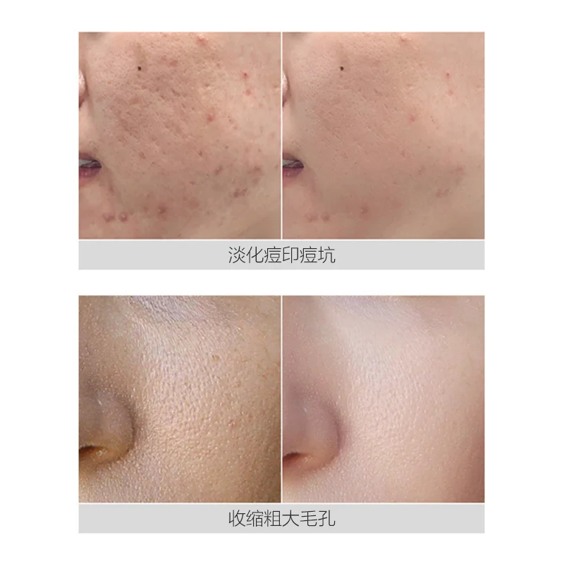 WXE лиофилизованный Эпидермальный фактор роста порошок сыворотка акне прыщи