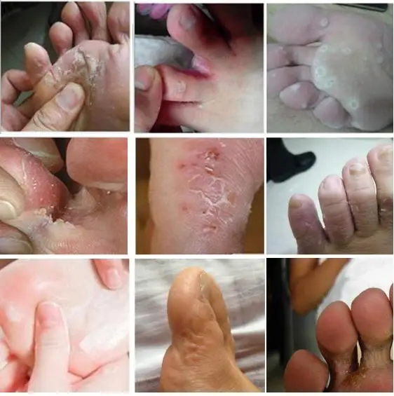 Free Delivery Beriberi cream 25g smelly feet itchy ringworm sweat /3 boxes | Красота и здоровье