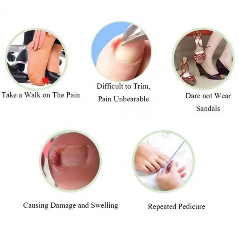 10pcs/Box Ingrown Toe Nail Correction Sticker Patch Paronychia Corrector File Elastic Foot Care Treatment Boxed | Красота и здоровье