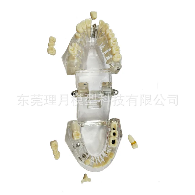 Смоляная съемная модель зубов стоматологическая передвижная патологическая