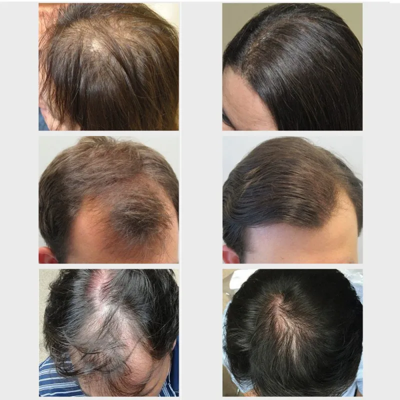 20 мл Новый экстракт имбиря эфирные масла для роста волос Быстрый мощный Уход за