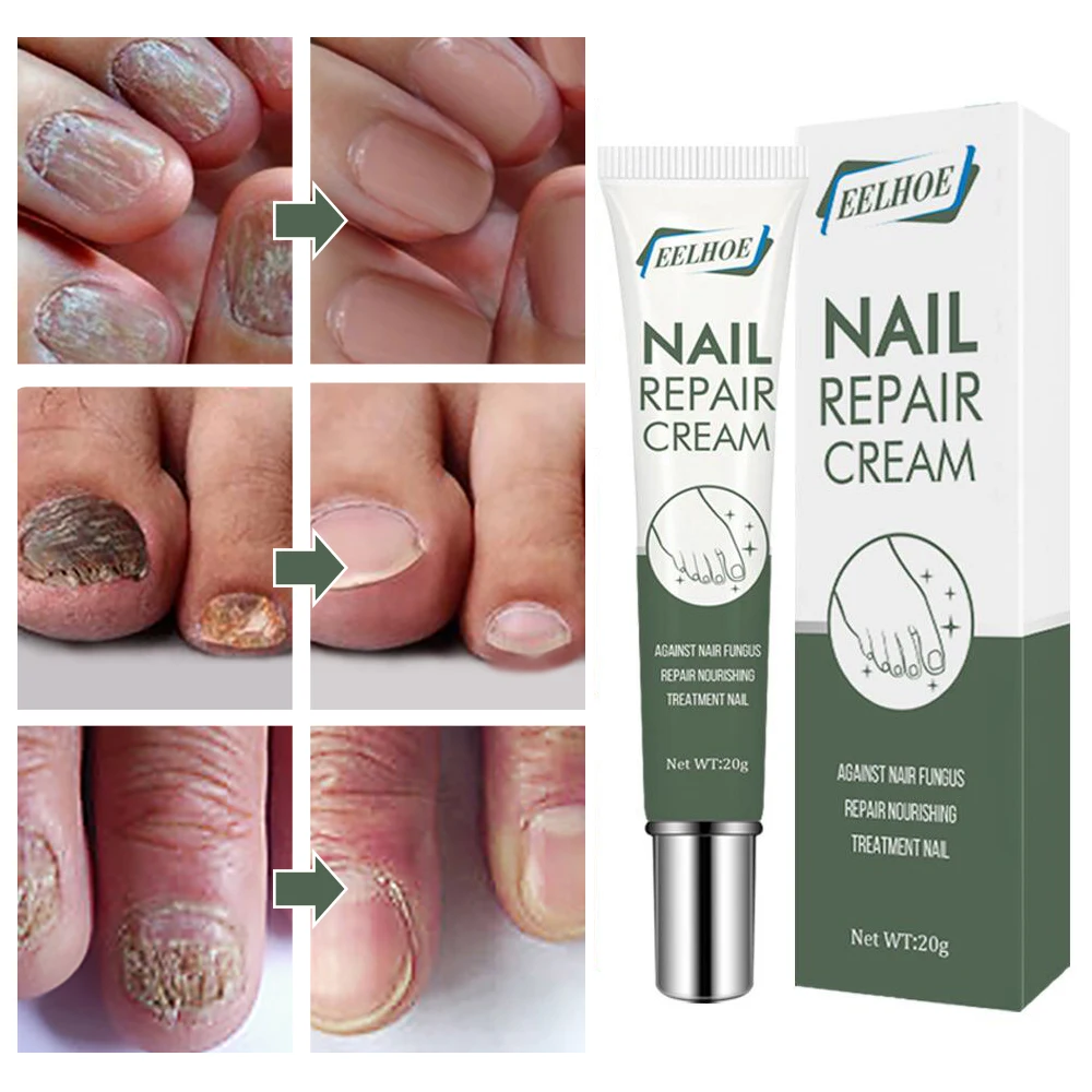 

Fungus Nail Care Serum Hand For Foot Treatment Anti-bacterial Infection Removal Paronychia Onychomycosis Gel Nail Repair Care