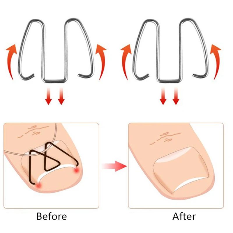 

1Box Ingrown Toe Nail Correction Wire Fixer Pedicure Paronychia Recover Embed Toenail Correction Lifter Tool Kit Inset Buckle