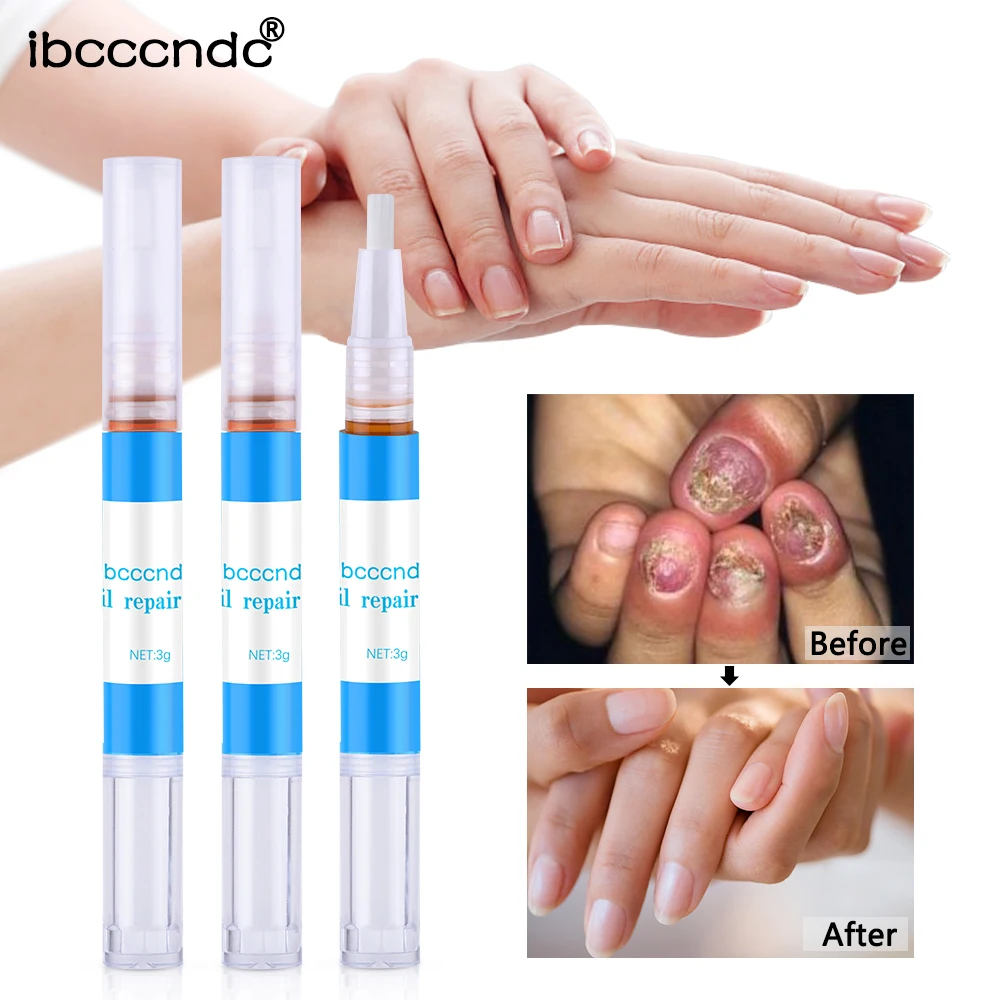 Жидкая ручка для восстановления ногтей 3 шт. эффективная от грибков онихомикоза