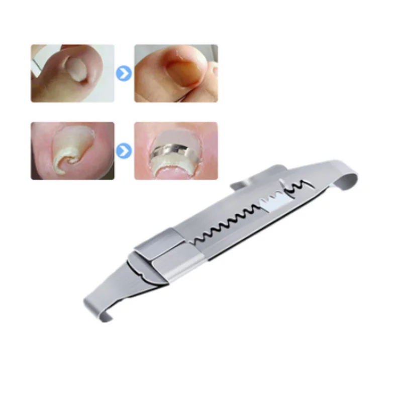 Инструменты для педикюра вросших ногтей на ногах профессиональное лечение