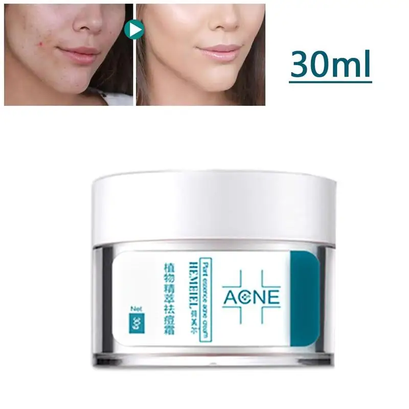 

Acne Treatment Face Cream Anti Acne Scar Removal Pimple Blackhead Removal Face Cream