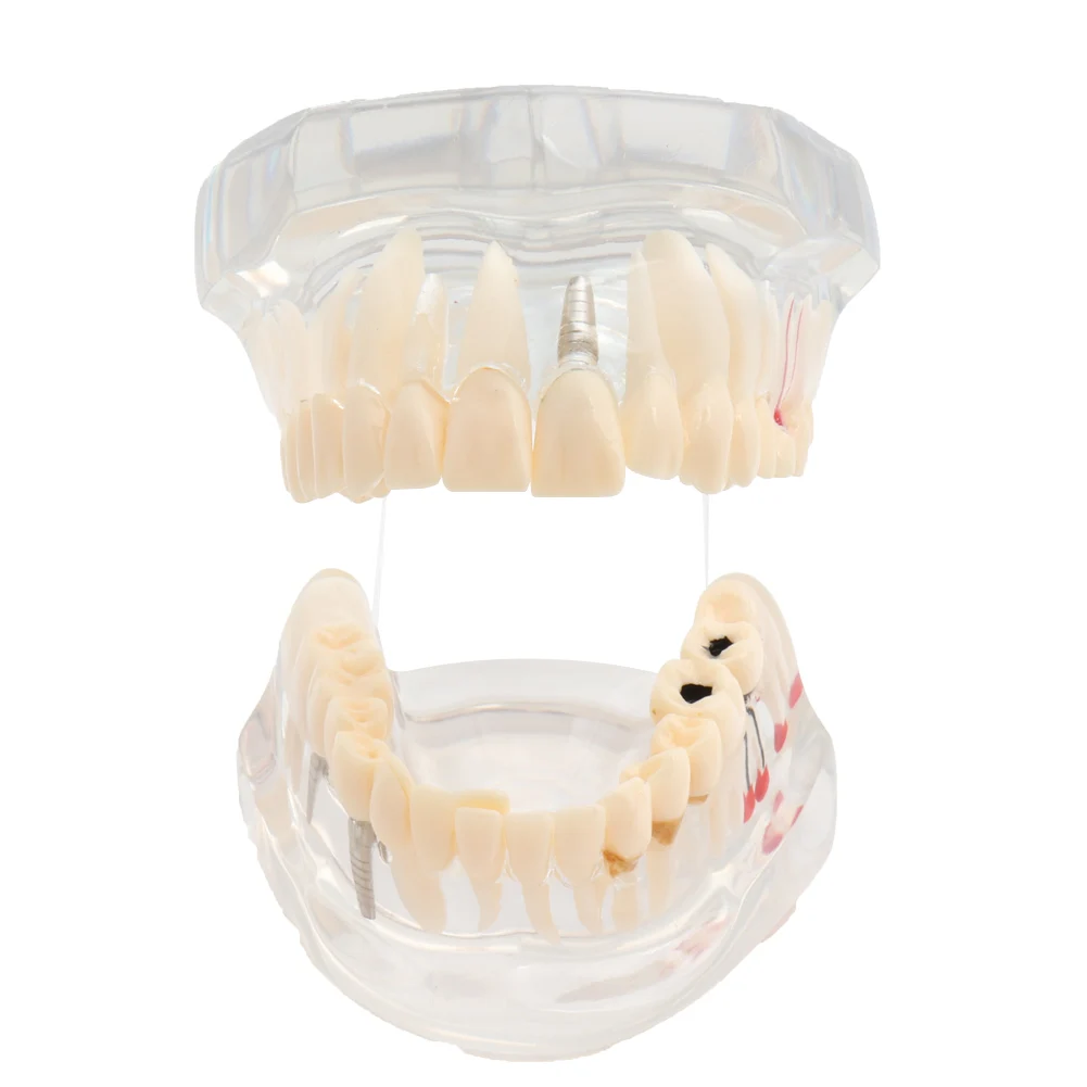 Зубная модель зубов имплантат и реставрация прозрачное исследование