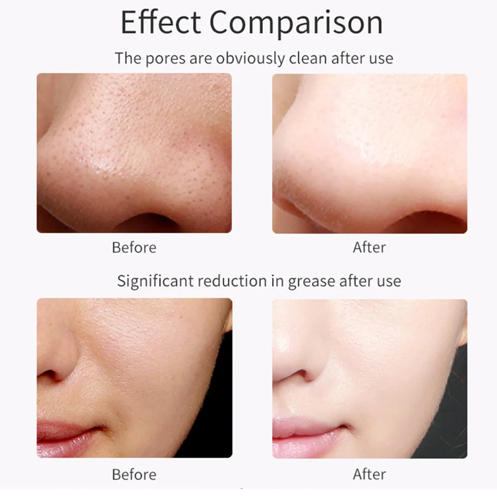 Ультразвуковой скребок для лица Beauty Kemei аппарат удаления черных точек с