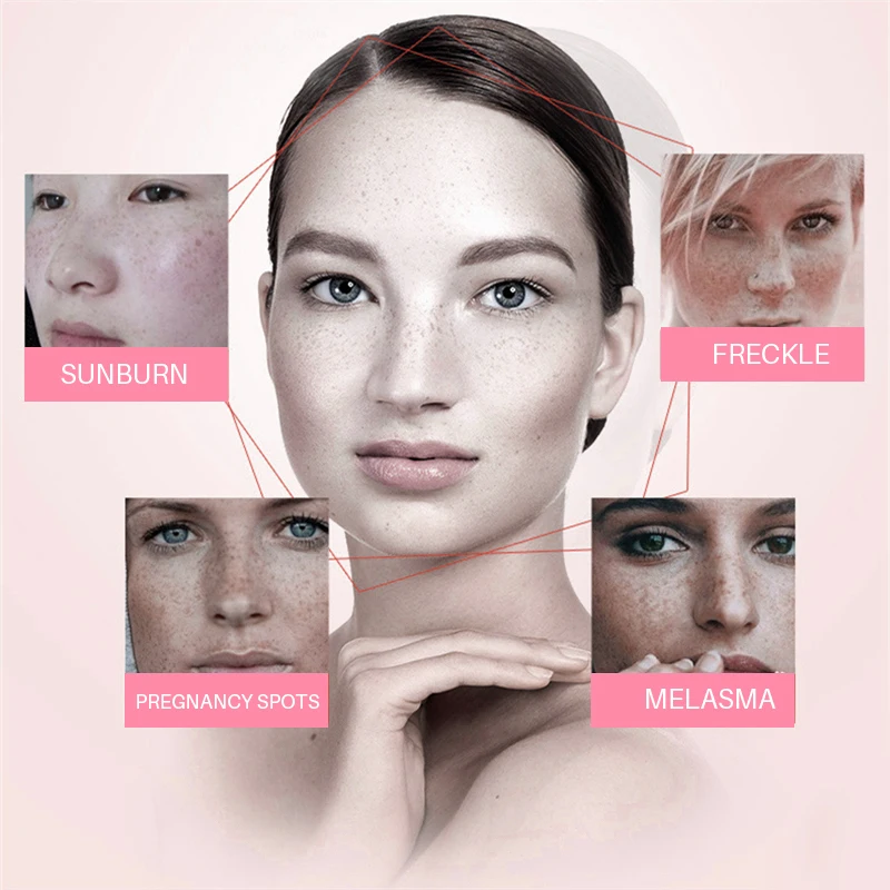 

Skin Whitening Cream Freckle Cream Remove Melasma Acne Dark Pigment Spots Melanin Pimple Cream Face Cream Face Serum Skin Care