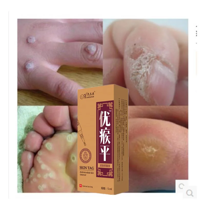 Набор для удаления бородавок на ногах антибактериостатический набор быстрого и