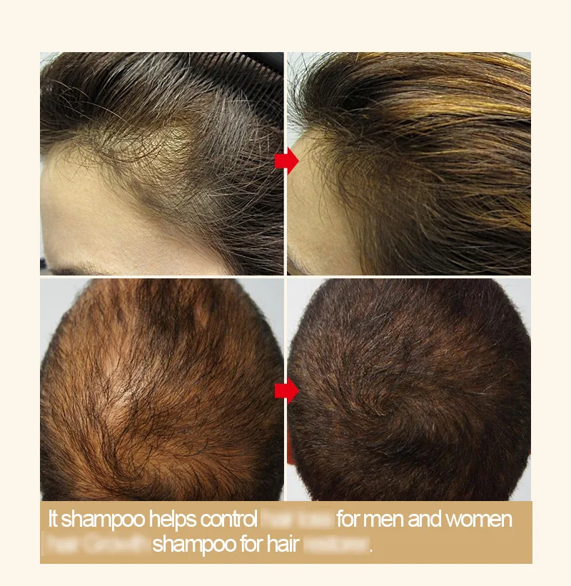 

Hairinque Ginger Shampoo Conditioner Set Mild Non-Irritating Nourishing Hair Root Hair Care Set