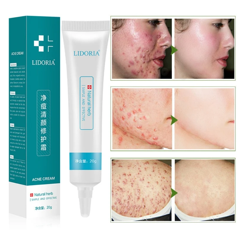 Acne Treatment Hyaluronic Acid Face Cream Acne Scar Remove Skin Care Shrink Pores Blemish Facial Spot Cream