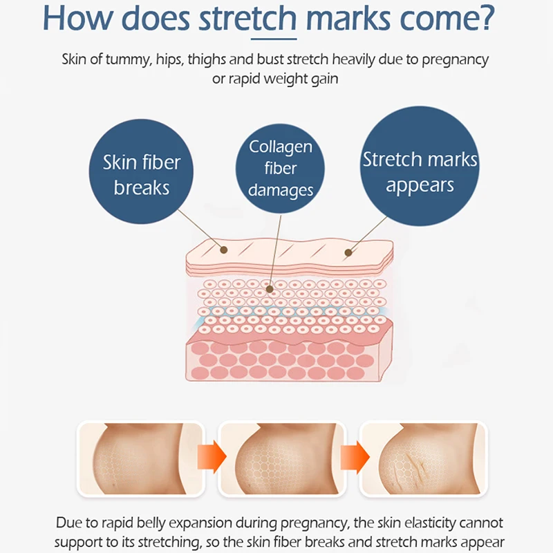 Яркий гламурный крокодиловый растягивающийся крем для удаления шрамов