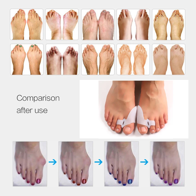 

Toe Separator Big Bone Hallux Valgus Corrector Silicone Gel Foot Fingers Toe Stretcher Bunion Corrector Pedicure Foot Care