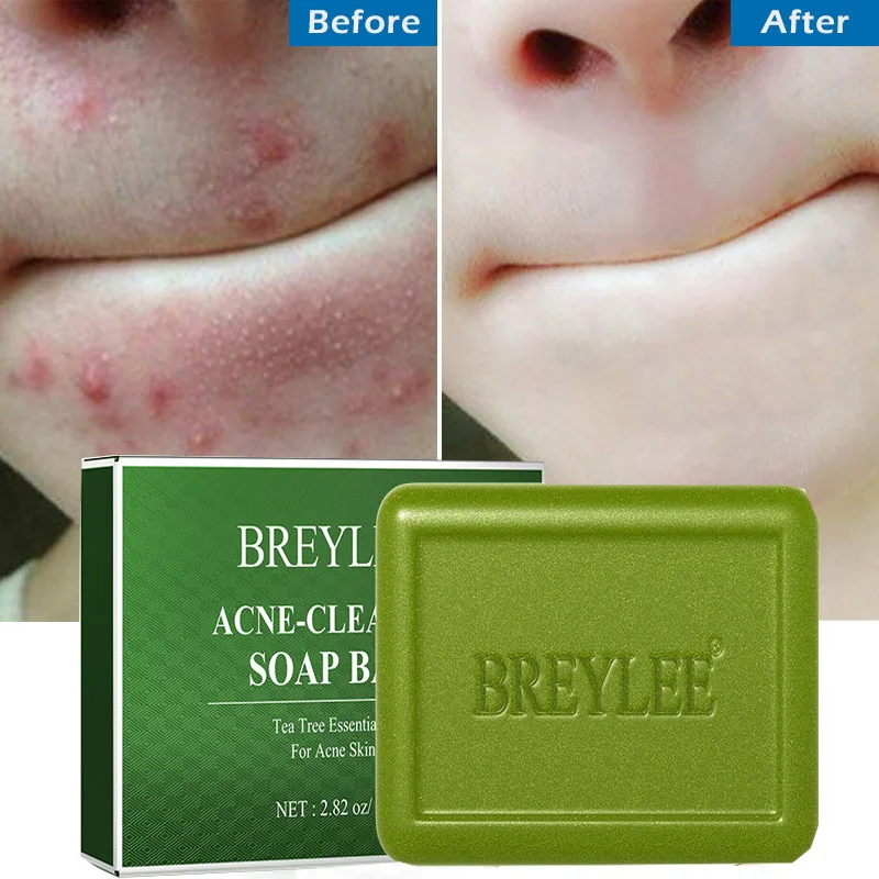 BREYLEE Acne Tea Tree Face Soap Bar Oil Control Pore Deep Cleansing Remove Blackhead Pimple Shrink Pore Moisturizing Skin Care