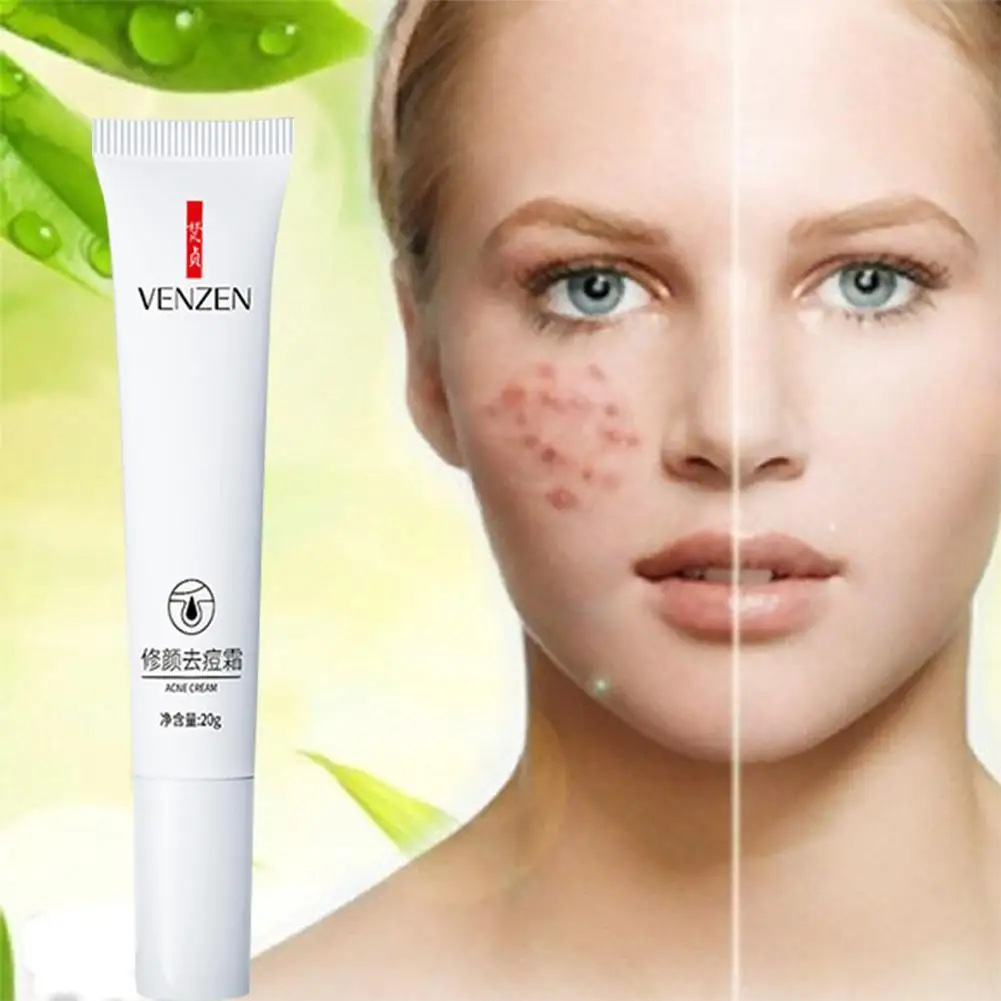 

Acne Treatment Face Cream Anti Acne Oil Control Shrink Care Marks Cream Pores Whitening Removal Pimple Stretch Moisturizer I8G4