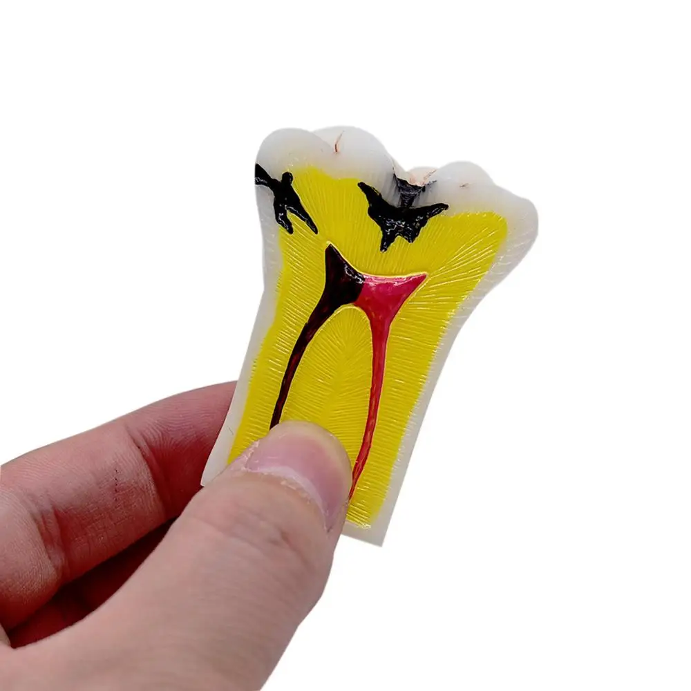 Модель для обучения стоматологии общение пациента модель кариеса разложения