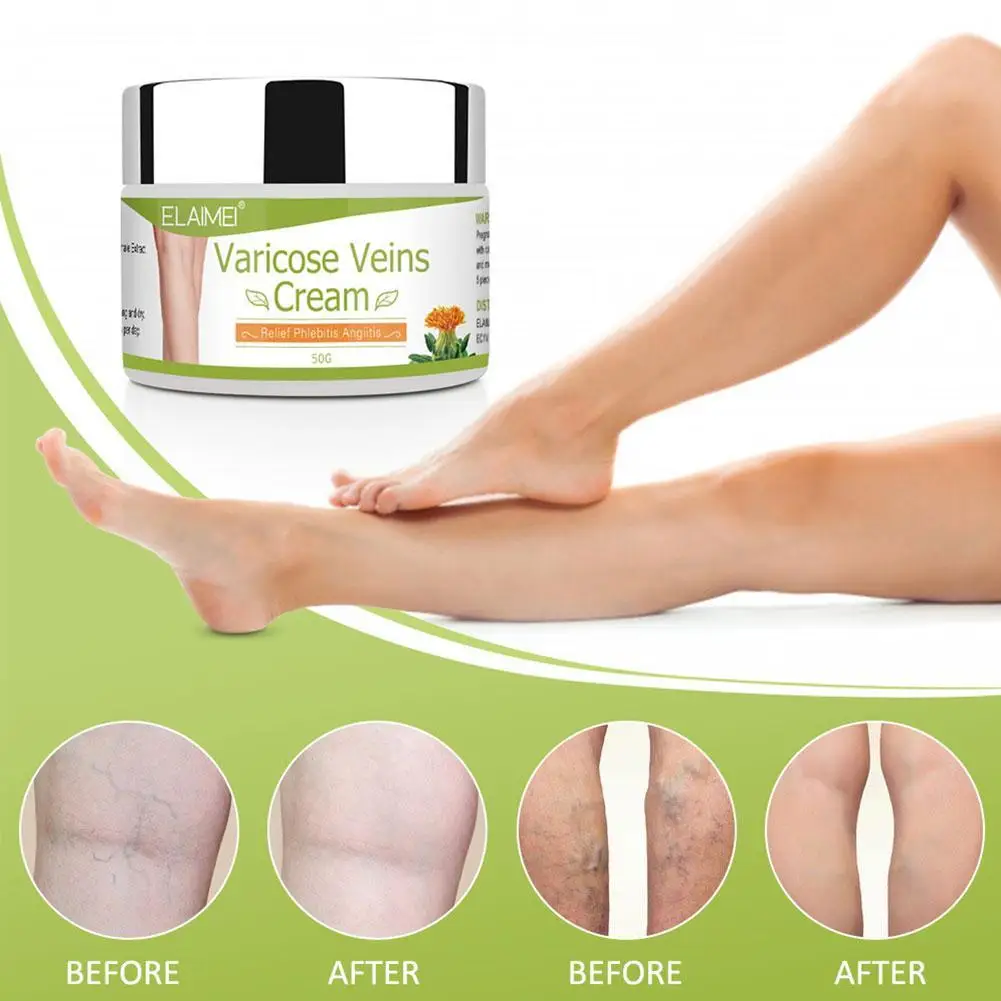 

Varicose Vein Ointment Improves Spider Vein Nourishment, The Soothes Skin And Moisturizes A1J9