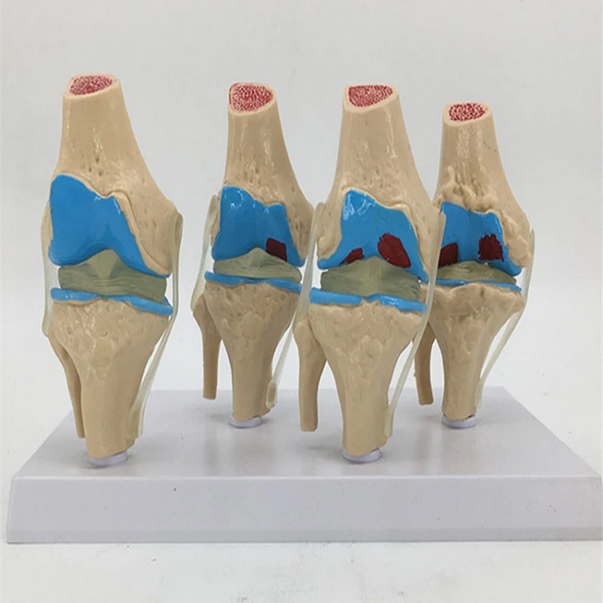 

1pcs Anatomical Human Knee Joint Model Human Stage 4 Knee Joint Model for School Teaching Display Models Disease Process