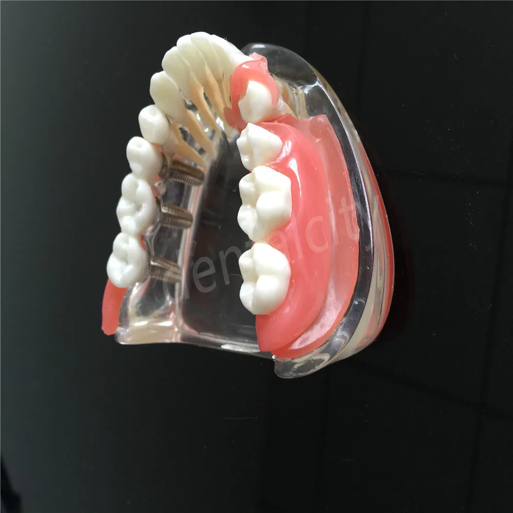 Модель имплантата для зубных протезов с сосудов демонстрация 6006 | Красота и