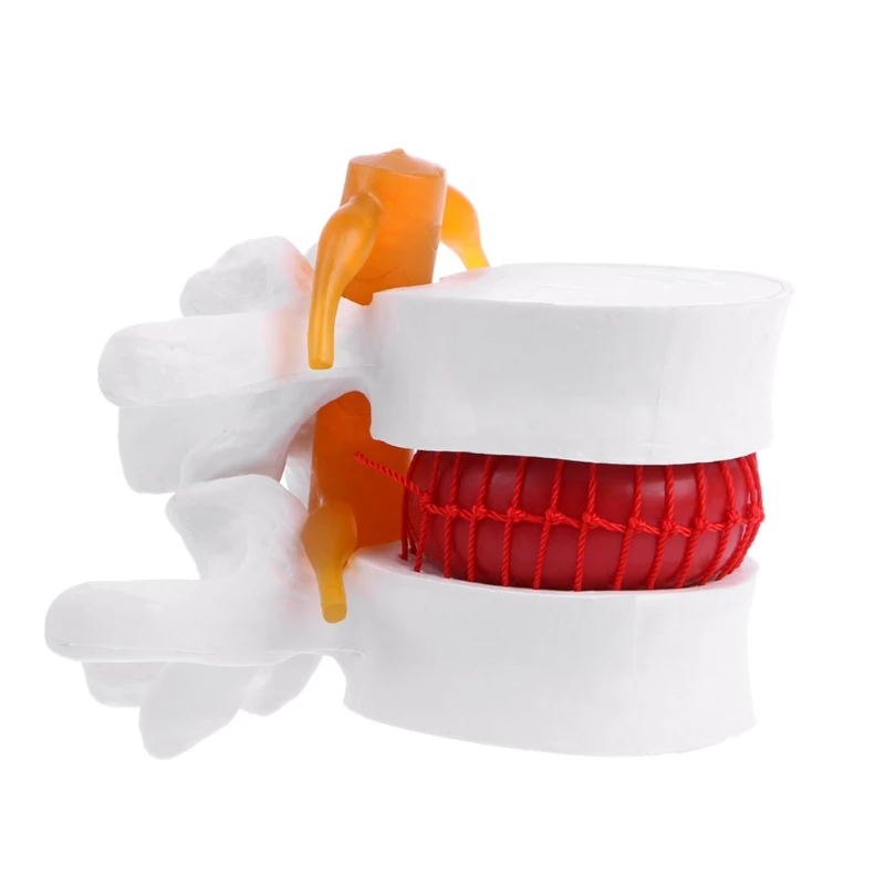 

Human Anatomical Lumbar Disc Herniation Model Learn Aid Anatomy Instrume
