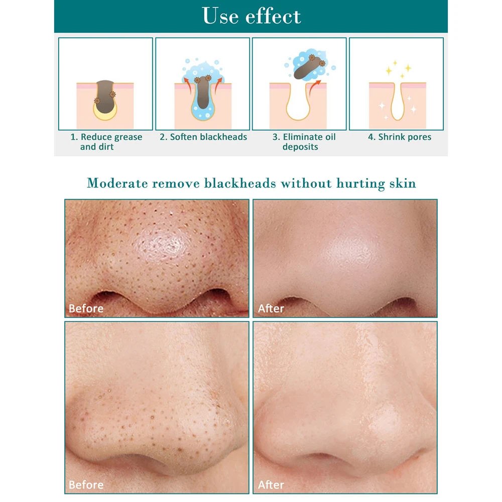 FTEENPLY маска для лица Сыворотки удаления черных точек носа что обеспечивает