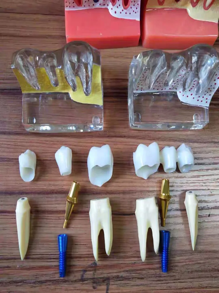 1 шт. 4 кратная модель имплантатов зубов орального обучения стоматологической