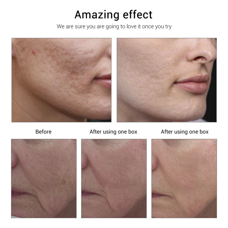 5/8/10/90 шт. Витамин Е эссенция акне удаление увлажняющий крем отбеливающий