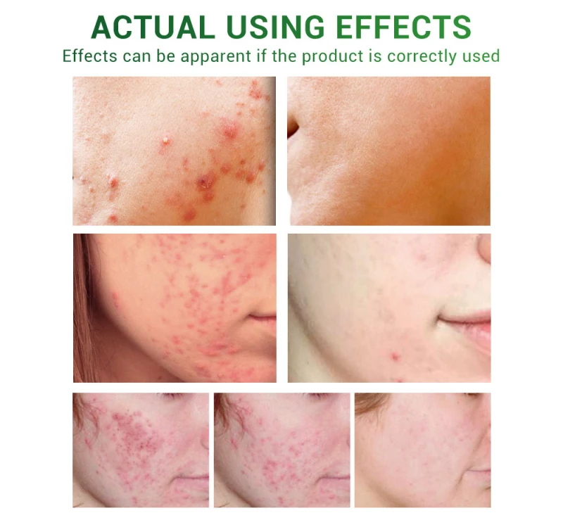 

Acne Treatment Serum Oil Control Scar Removal Anti Acne Essence Oil Control Shrink Pores Anti-aging Whitening Skin Care TSLM2