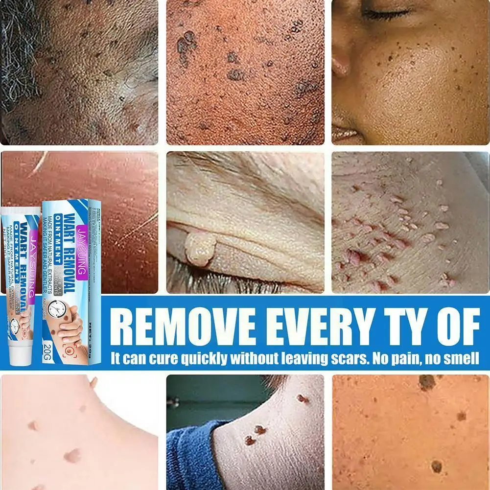 

Крем для удаления бородавок, 20 г, искусственная мазь, крем для лечения бородавок, искусственная кожа, пластырь, бирка, травяной экстракт, маз...